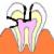 虫歯の進行C3